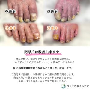 肥厚爪・巻き爪ケア