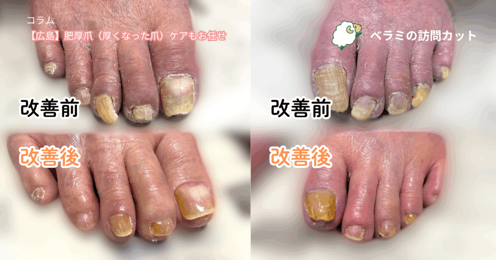 【広島】肥厚爪（厚くなった爪）ケアもお任せ