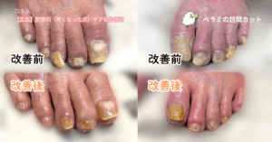 【広島】肥厚爪（厚くなった爪）ケアもお任せ